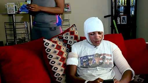 Viral internet challenge leaves teen with second-degree burns