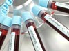 Four more from Kandakadu rehab center test coronavirus-positive