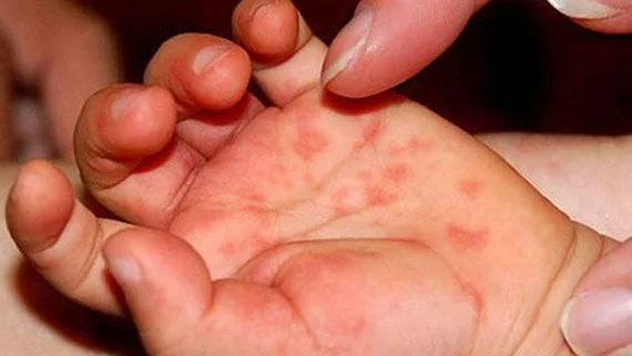 Health officials warn over spread of hand, foot and mouth disease