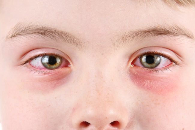 Peadatrician raises concerns over rapidly-spreading eye disease amongst children 