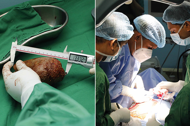 Sri Lanka Army doctors set Guinness World Record for largest kidney stone removal surgery