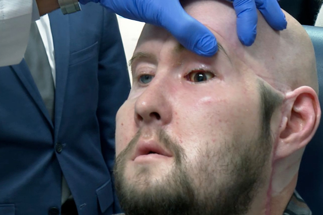 Worlds first whole-eye transplant hailed as breakthrough 