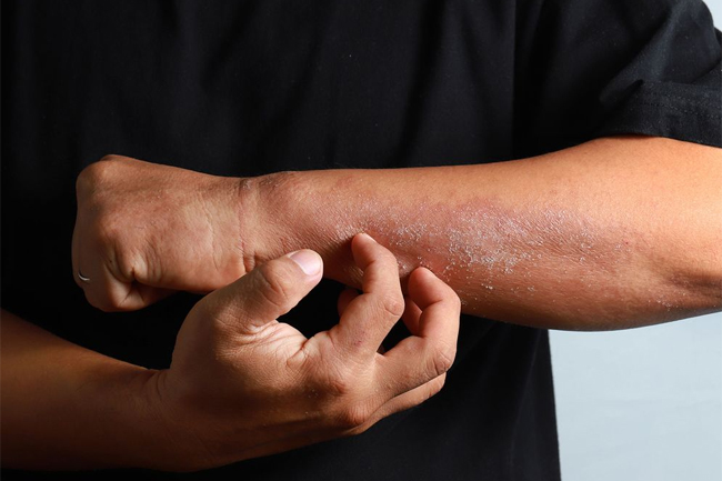 Dermatologists raise concerns about skin diseases as extreme heat prevails