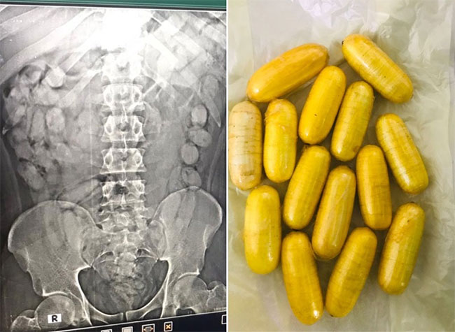 Ugandan man who ingested cocaine-filled capsules arrested at BIA