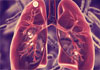 Tuberculosis on the rise in Kandy: 50 cases reported so far in 2024