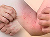 Health authorities warn of spike in dengue and chikungunya cases