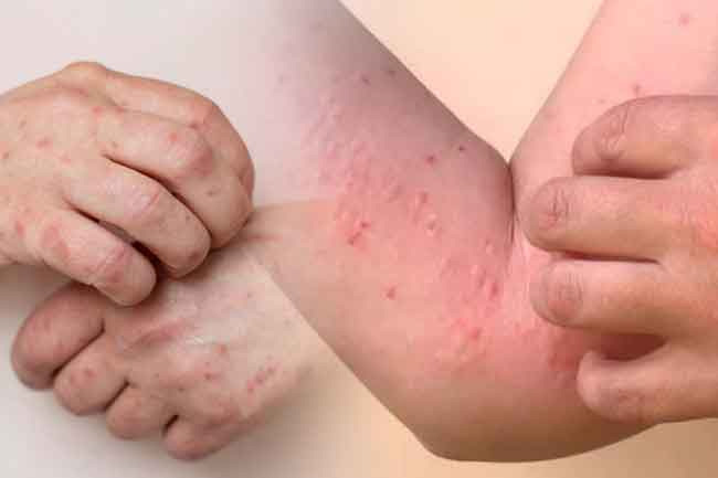 Health authorities warn of spike in dengue and chikungunya cases