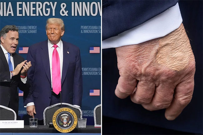 White House says Trump diagnosed with vein condition after questions about bruises