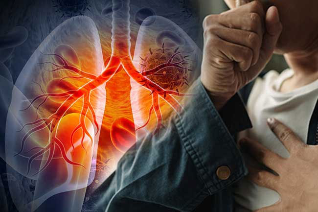 Lung cancer more prevalent among men compared to women, experts say 