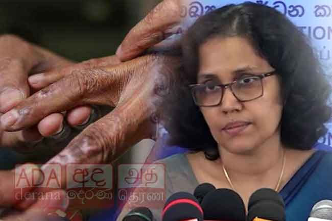 1,282 leprosy patients identified in Sri Lanka in 2025- Health officials