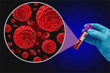 100 new cancer cases detected in Sri Lanka daily - Deputy Health Minister