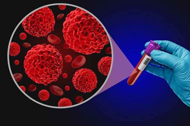 100 new cancer cases detected in Sri Lanka daily - Deputy Health Minister