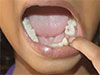 60% of Grade One entrants in Nuwara Eliya schools suffer from decayed teeth