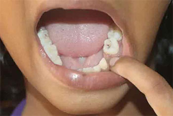 60% of Grade One entrants in Nuwara Eliya schools suffer from decayed teeth