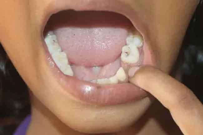 60% of Grade One entrants in Nuwara Eliya schools suffer from decayed teeth