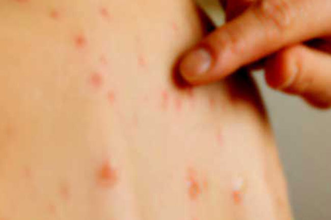 Sri Lanka reports first measles cases in years, authorities urge vaccination